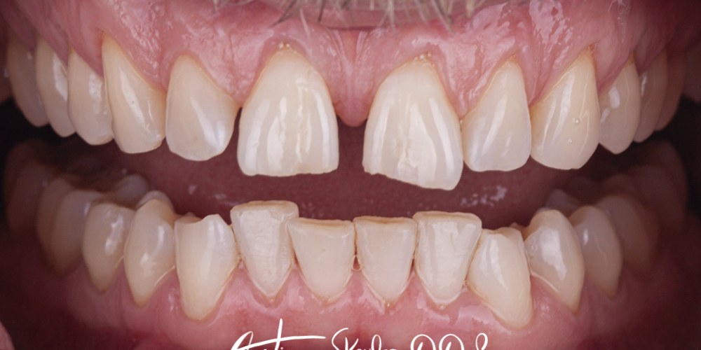 Invisalign Patient before treatment