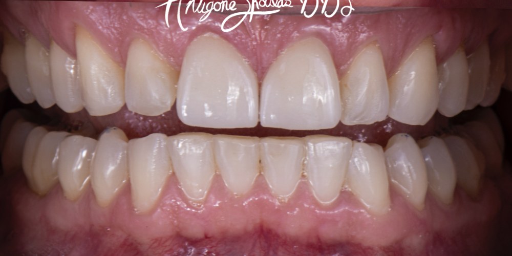 Invisalign Patient after treatment